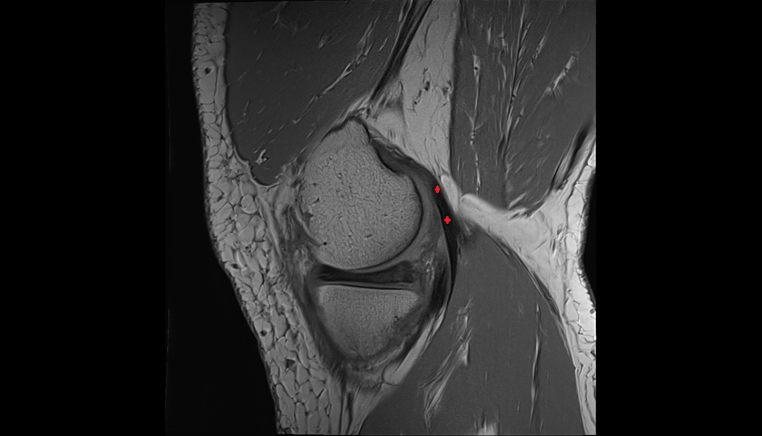 Medial gastrocnemius tendon sag  cross sectional anatomy 3T MRI  radiology  anatomy image-img-00000-00000