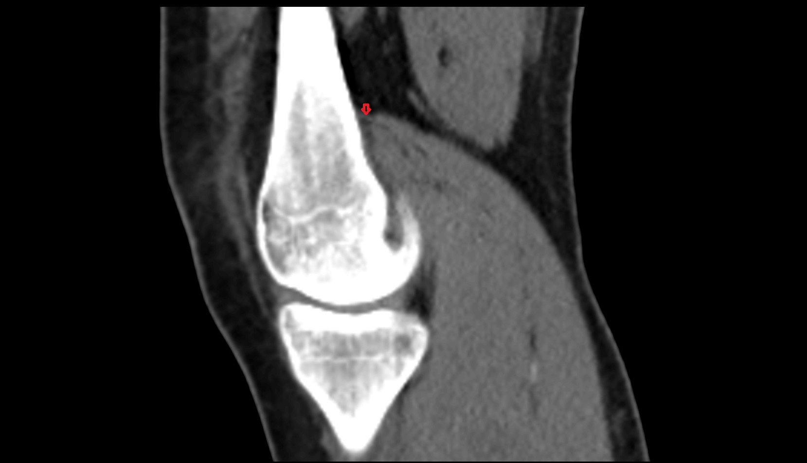 Medial gastrocnemius tendon sag image