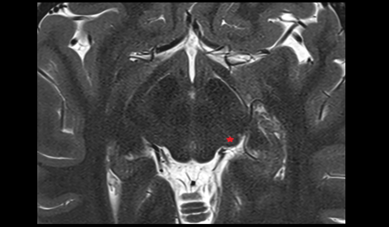 Medial geniculate body mri 3t axial image