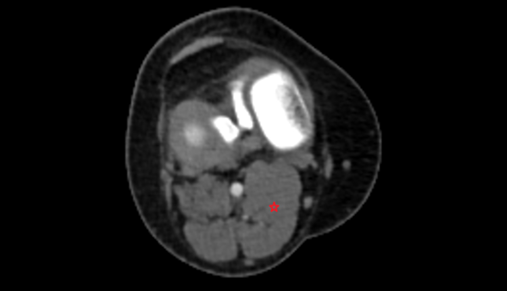 Medial head of gastrocnemius muscle ct axial image