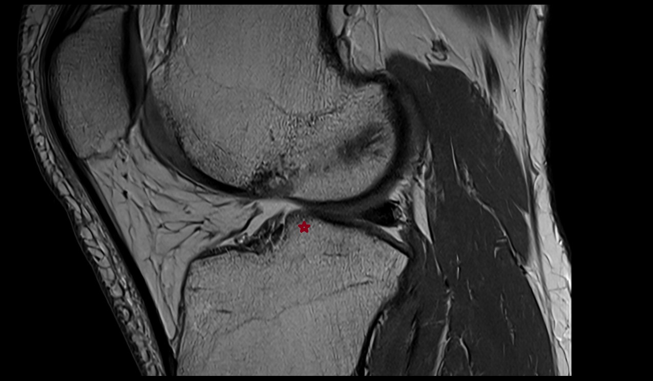 Medial intercondylar tubercle anatomy 3t mri