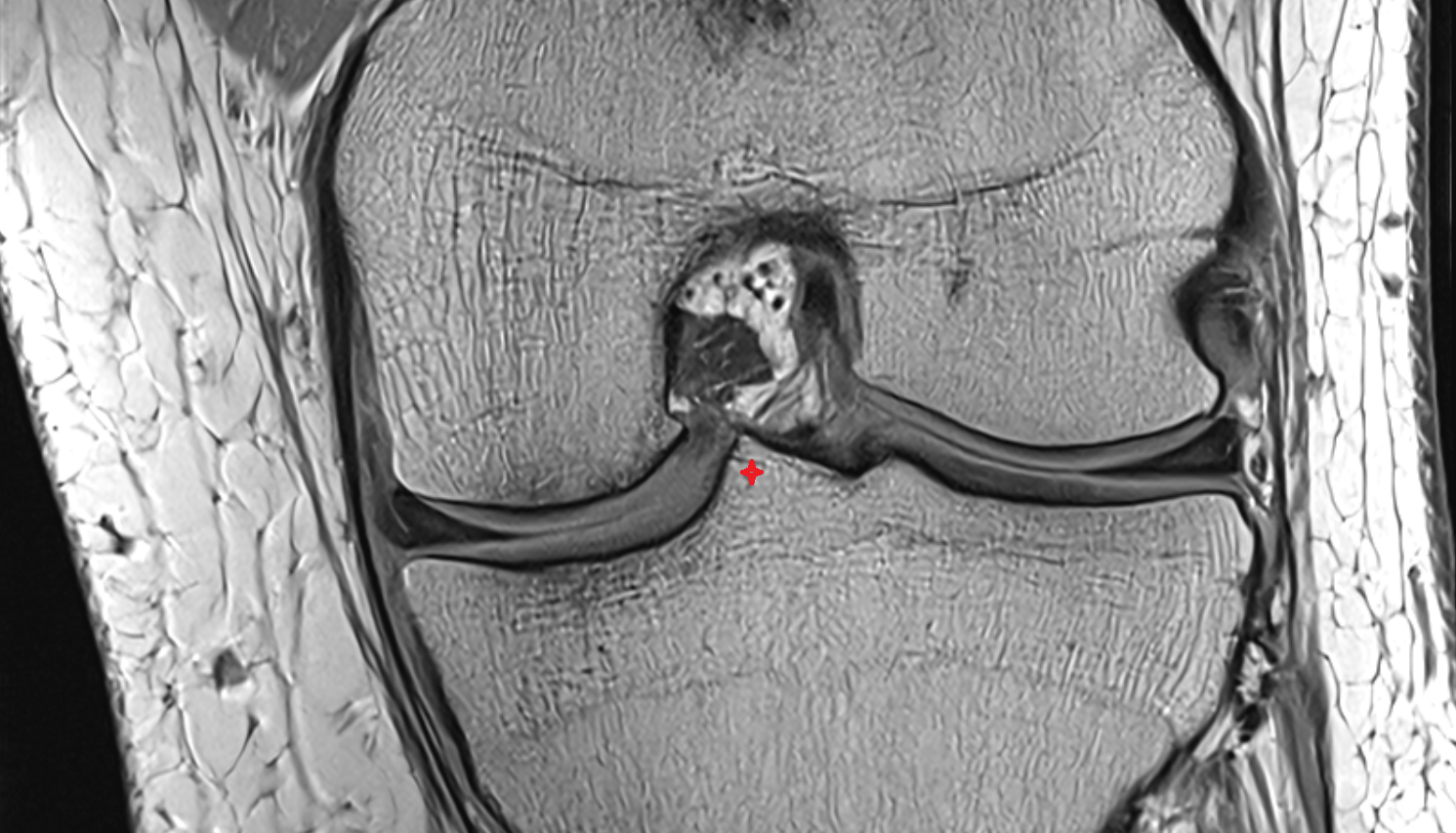 Medial intercondylar tubercle of tibia coronal cross sectional anatomy 3T MRI AI enhanced  radiology  anatomy image-img-00000-00000