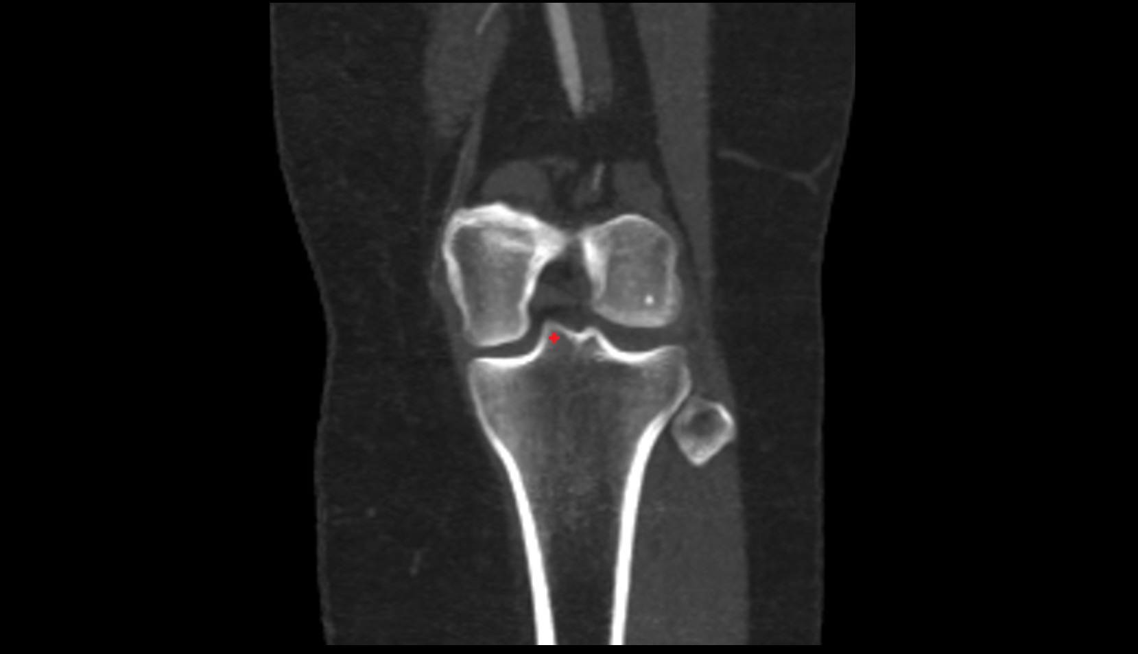 Medial intercondylar tubercle of tibia ct coronal image