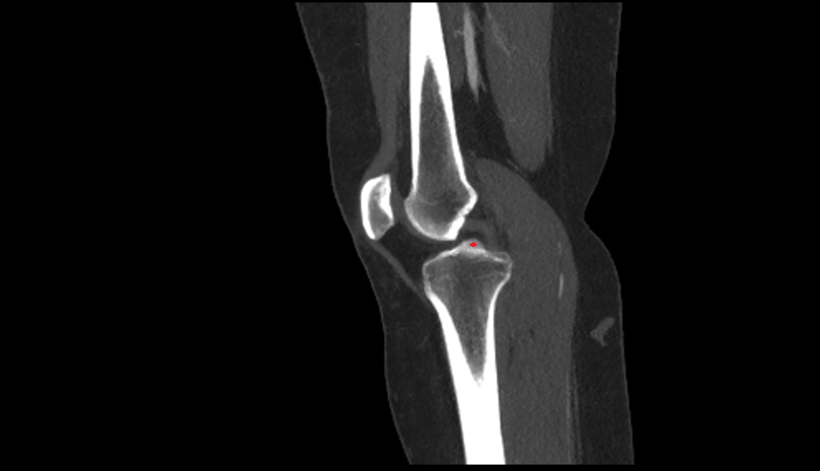 Medial intercondylar tubercle of tibia ct sag
