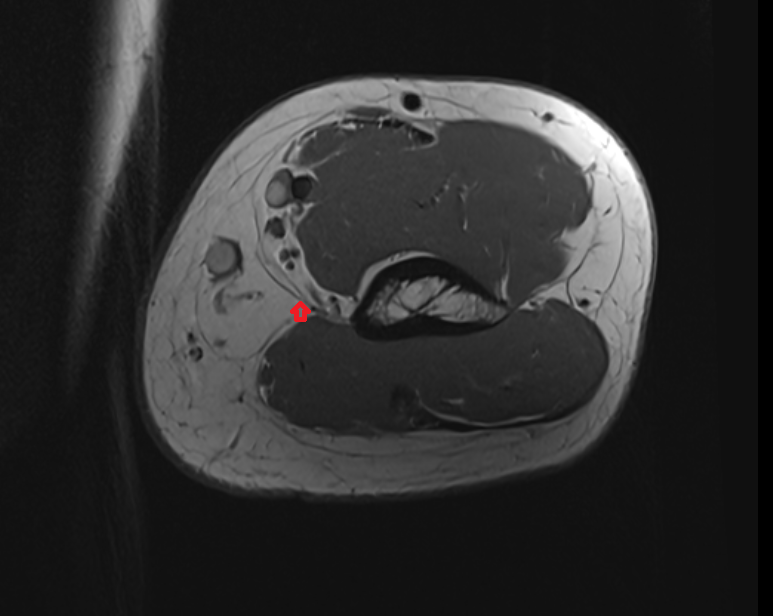 Medial intermuscular septum axial cross sectional anatomy 3T MRI AI enhanced radiology image -img-00000-00000