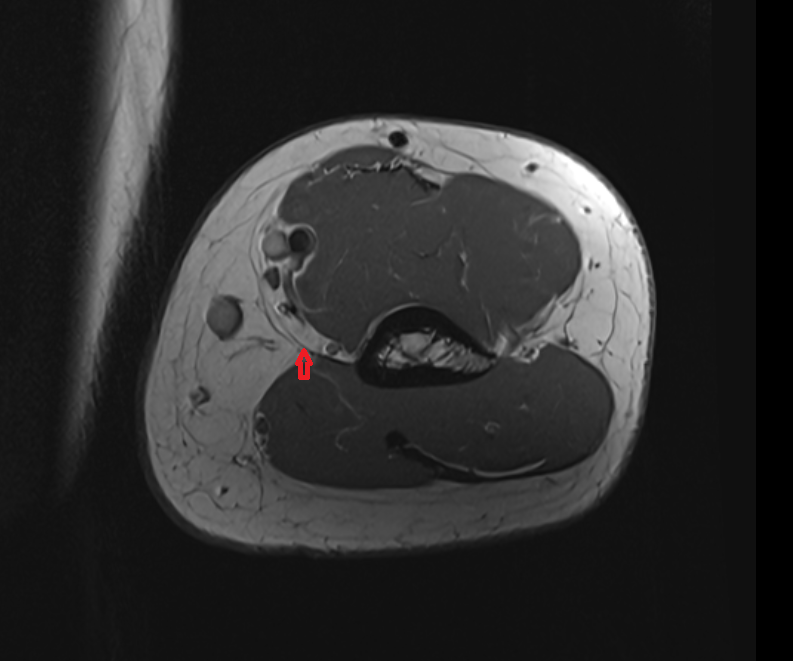 Medial intermuscular septum axial cross sectional anatomy 3T MRI AI enhanced radiology image -img-00000-00000_00001