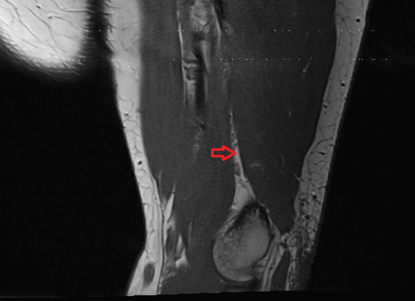 Medial intermuscular septum sag cross sectional anatomy 3T MRI AI enhanced radiology image -img-00000-00000