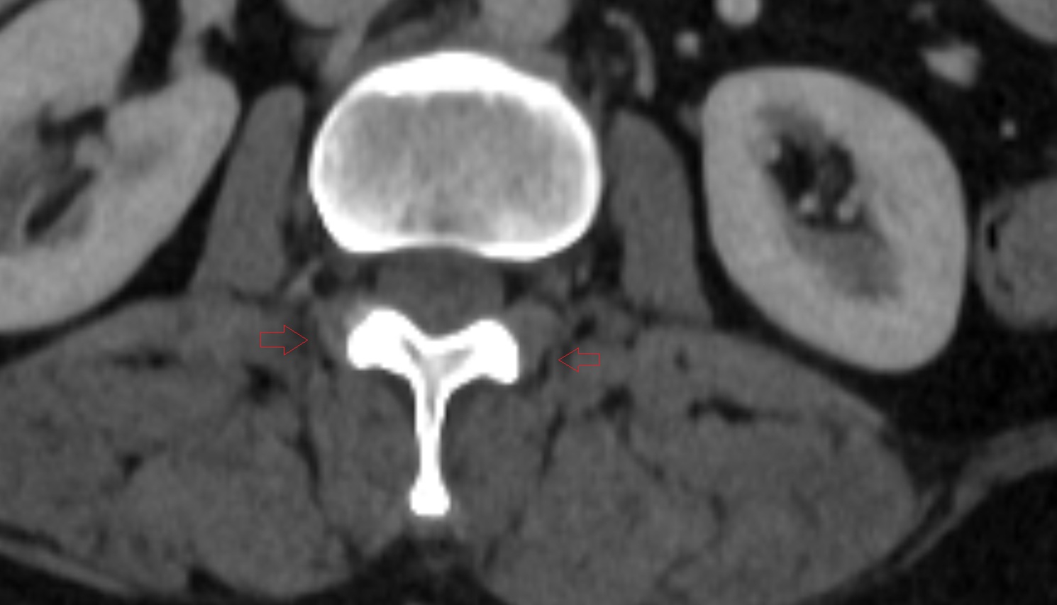 Medial intertransversarii lumborum muscle CT axial  anatomy  image-img-00000-00000