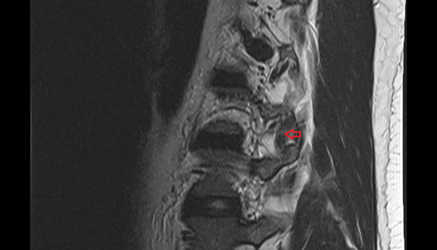 Medial intertransversarii lumborum muscle MRI  SAGITTAL  anatomy  image-img-00000-00000