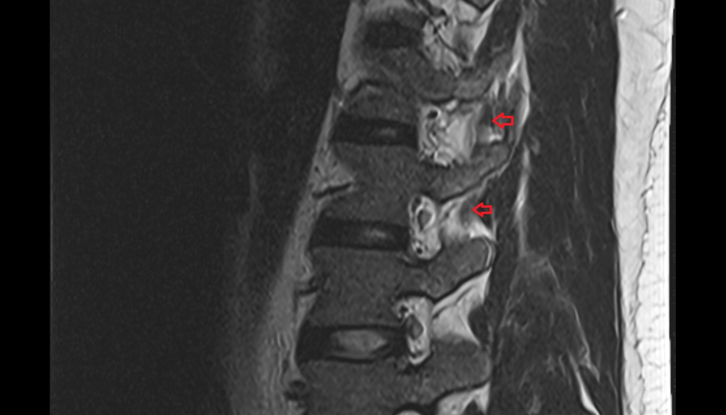 Medial intertransversarii lumborum muscle MRI  SAGITTAL  anatomy  image-img-00000-00000_00001