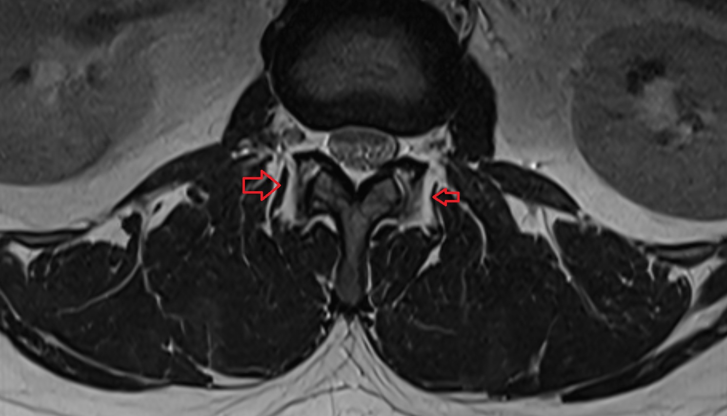 Medial intertransversarii lumborum muscle MRI  axial  anatomy  image-img-00000-00000