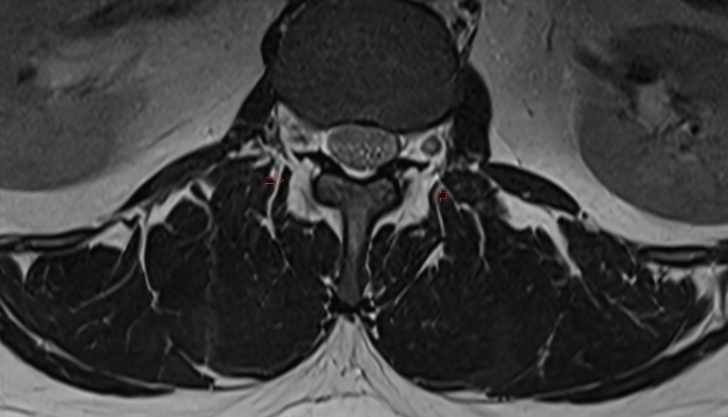 Medial intertransversarii lumborum muscle MRI  axial  anatomy  image-img-00000-00000_00001