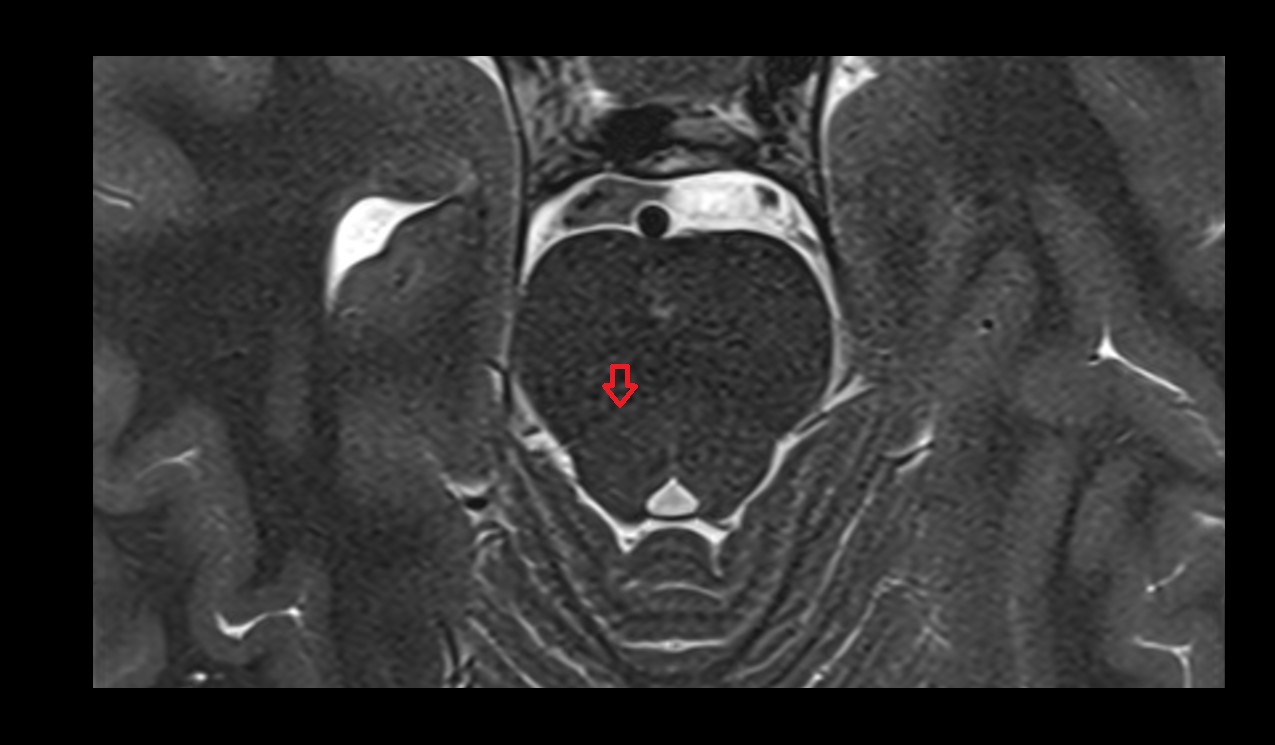Medial longitudinal fasciculus mri 3t axial image
