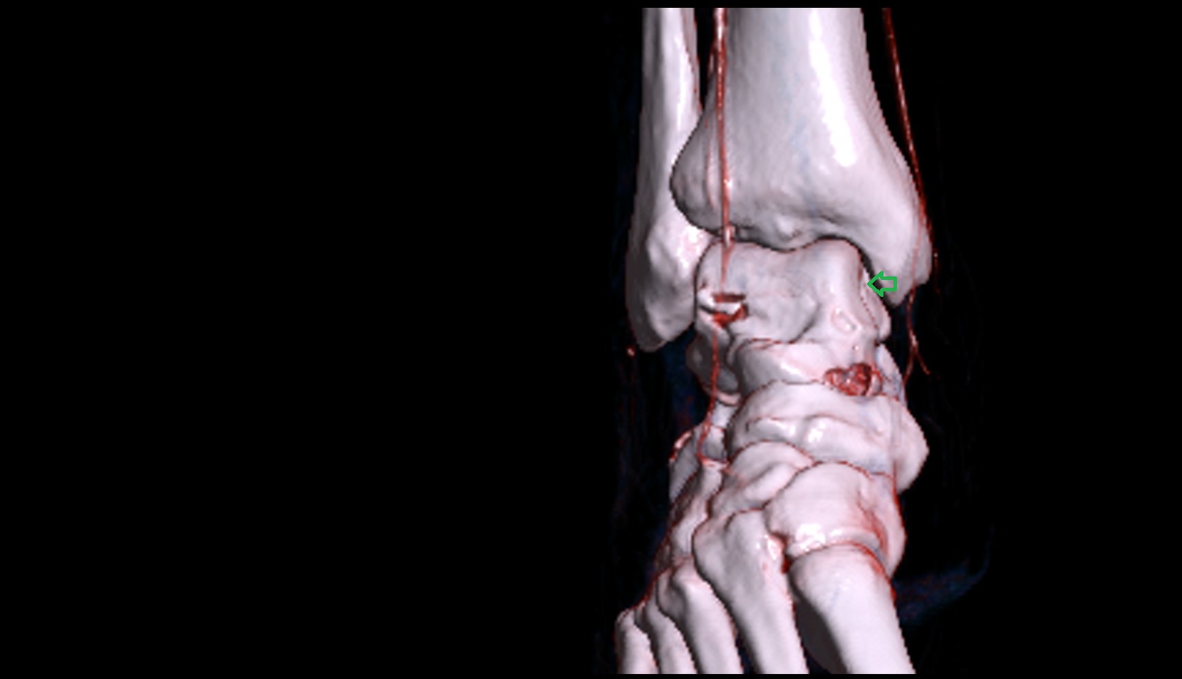 Medial malleolar facet of talus 3d