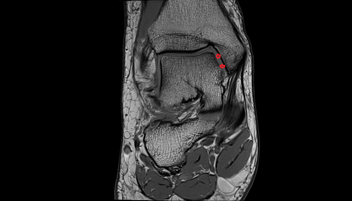 Medial malleolar facet of talus  mri  anatomy labelled image-img-00000-00000
