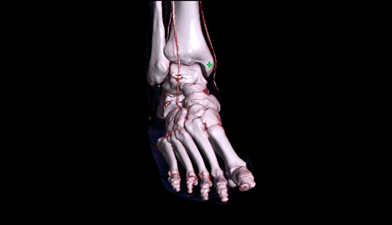 Medial malleolus 3d