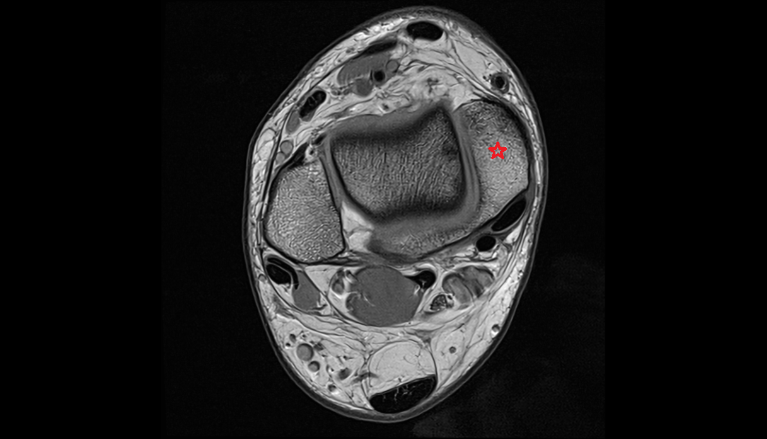 Medial malleolus  MRI axial  cross sectional anatomy 3T MRI AI enhanced radiology image-img-00000-00000