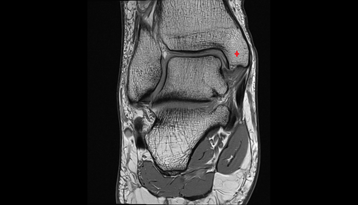 Medial malleolus  MRI coronal  cross sectional anatomy 3T MRI AI enhanced radiology image-img-00000-00000