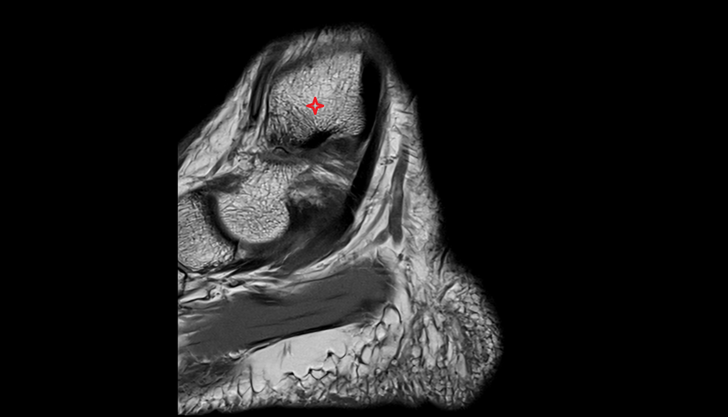 Medial malleolus  MRI sagittal  cross sectional anatomy 3T MRI AI enhanced radiology image-img-00000-00000