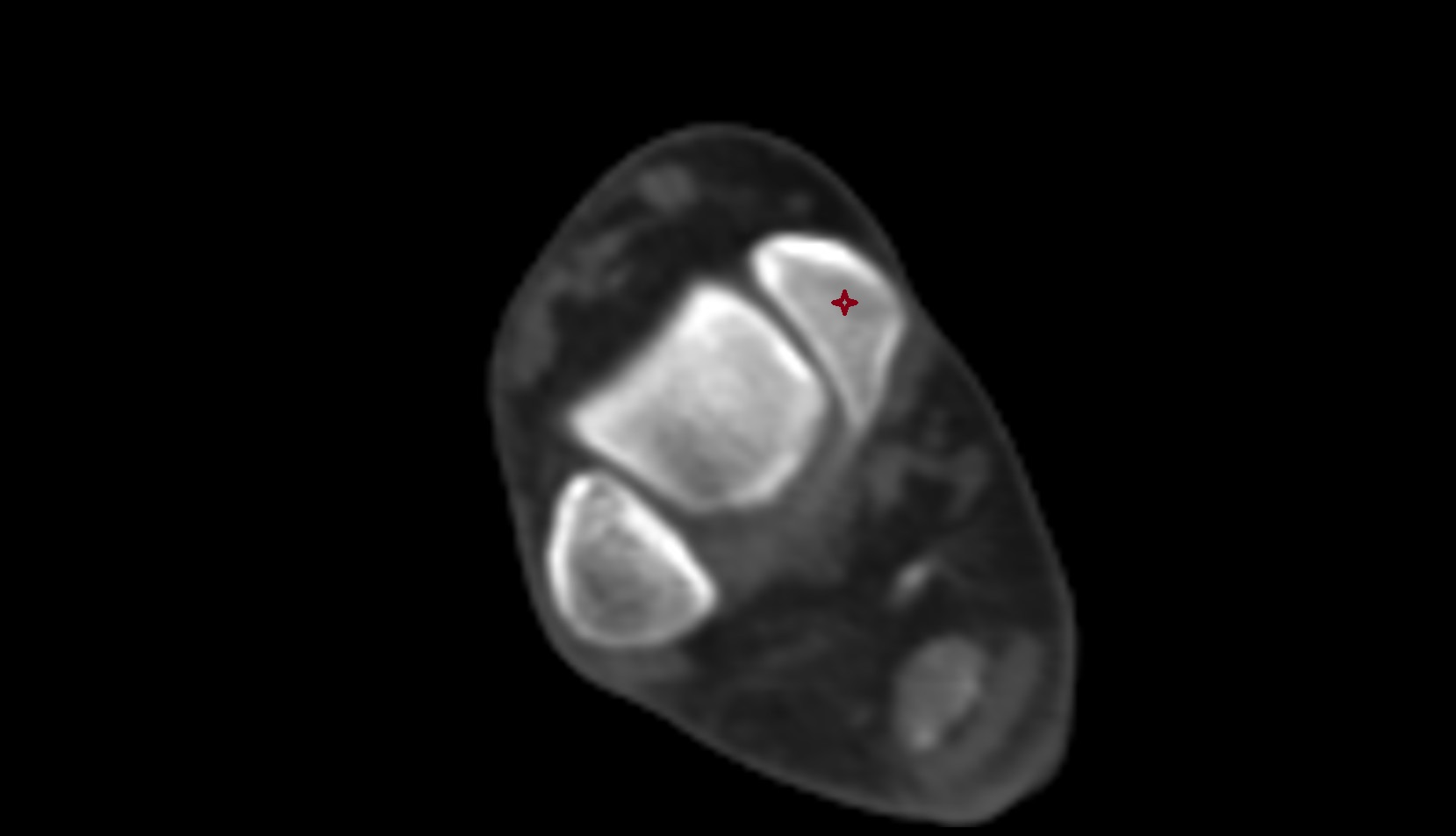 Medial malleolus ct axial