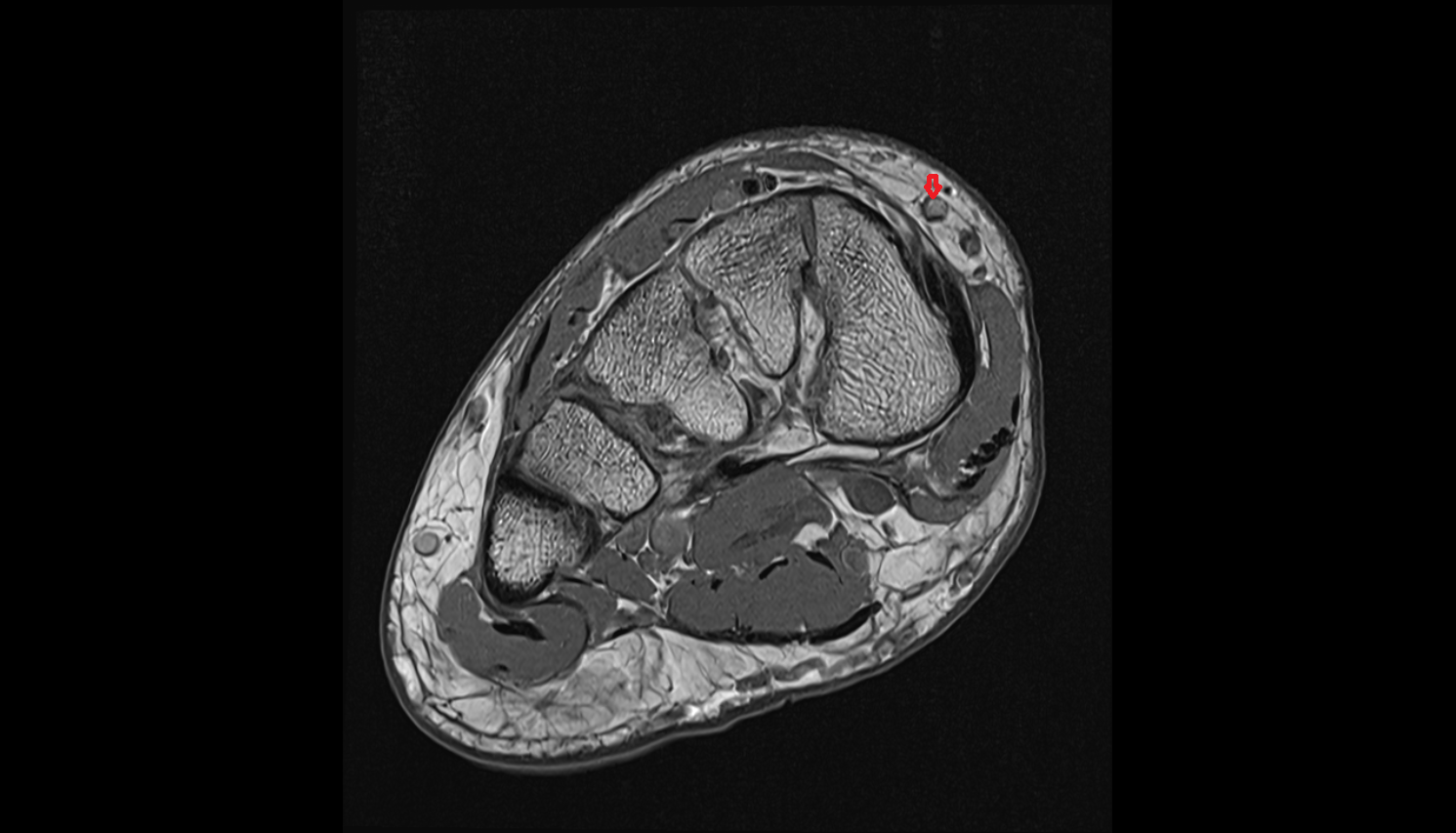 Medial marginal vein of foot axial cross sectional anatomy 3T MRI AI enhanced radiology image-img-00000-00000