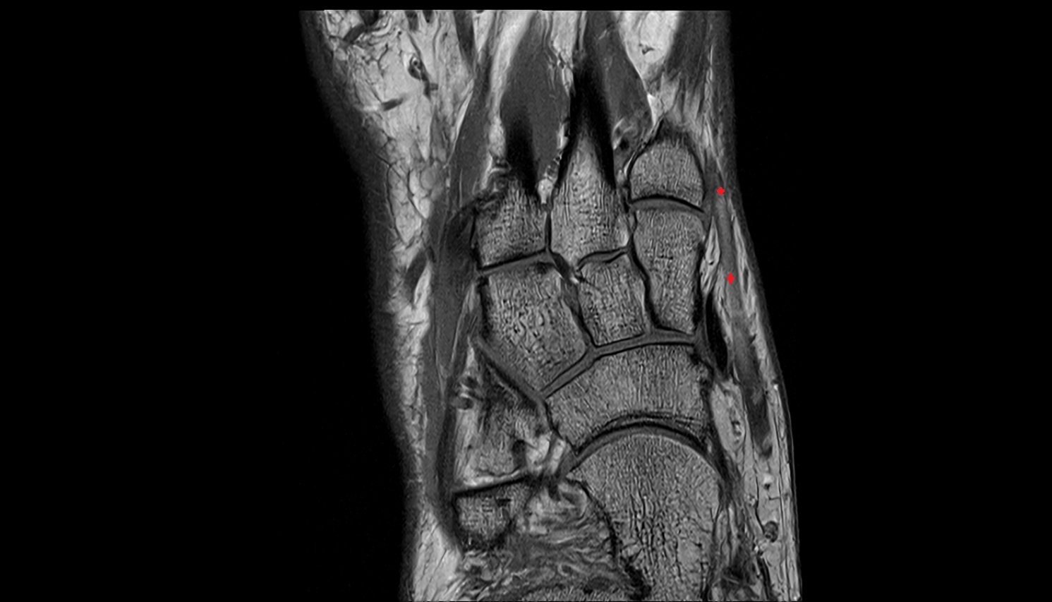 Medial marginal vein of foot coronal cross sectional anatomy 3T MRI AI enhanced radiology image-img-00000-00000