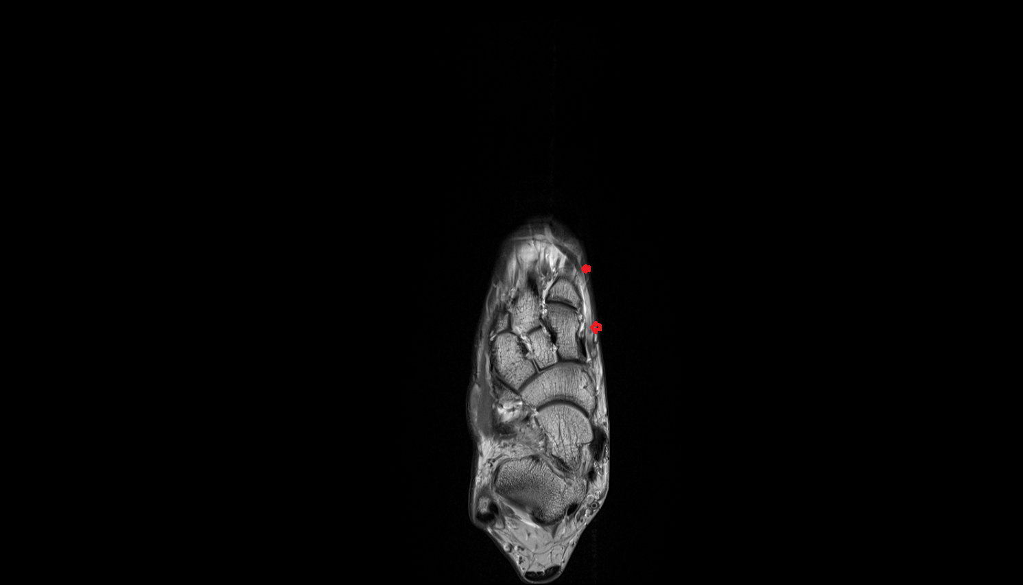 Medial marginal vein of foot coronal cross sectional anatomy 3T MRI AI enhanced radiology image-img-00000-00000_00001