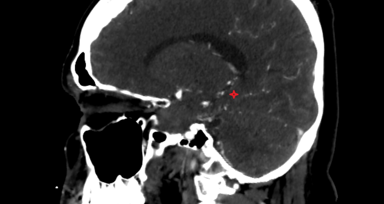 Medial occipitotemporal gyrus  CT sag anatomy image -img-00001-00001