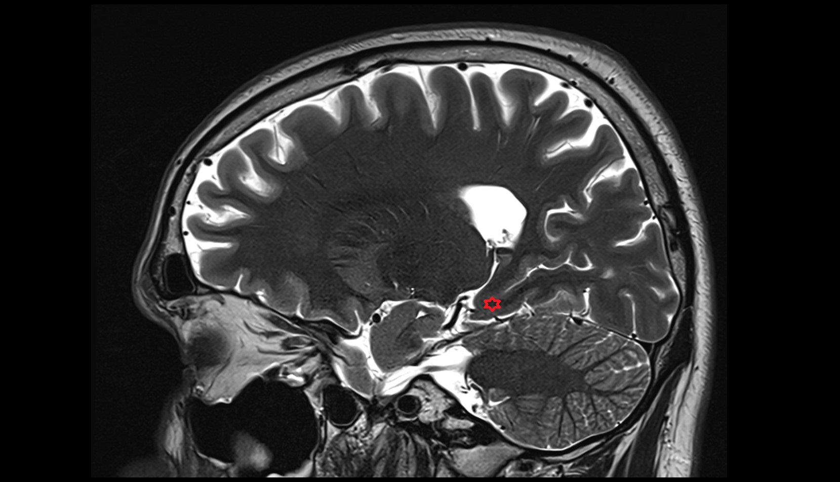 Medial occipitotemporal gyrus mri 3t sagittal image