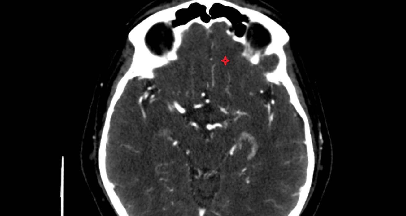 Medial orbital gyrus  CT axial anatomy image -img-00001-00001