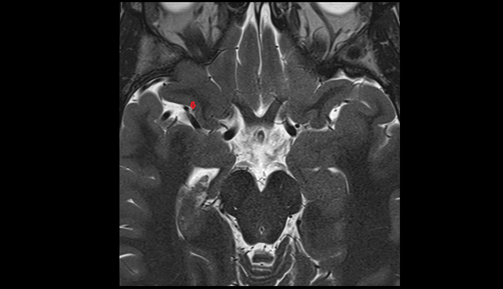 Medial orbitofrontal artery