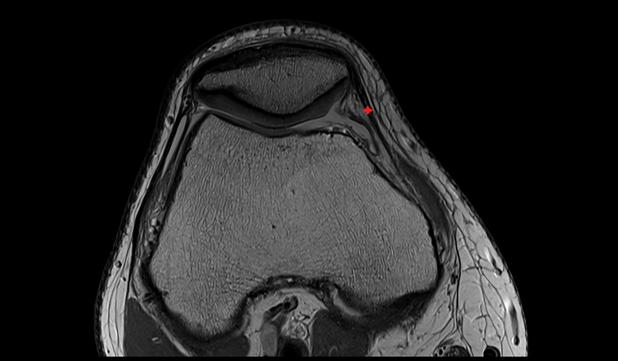 Medial patellar retinaculum anatomy image