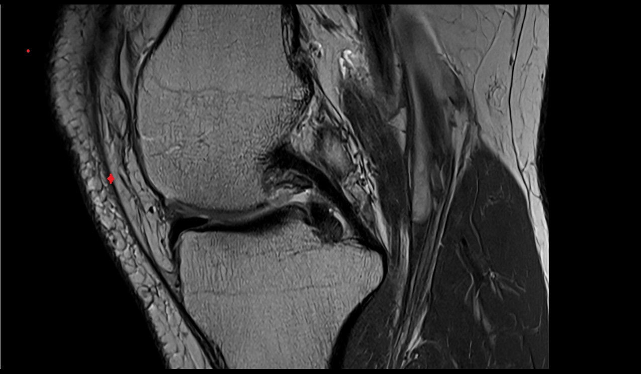 Medial patellar retinaculum anatomy image mri 3t