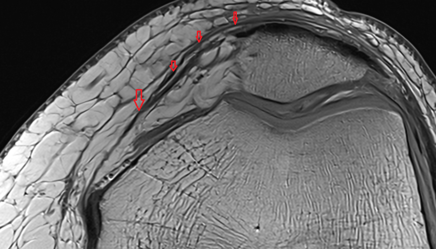 Medial patellar retinaculum axial   cross sectional anatomy 3T MRI AI enhanced  radiology  anatomy image-img-00000-00000