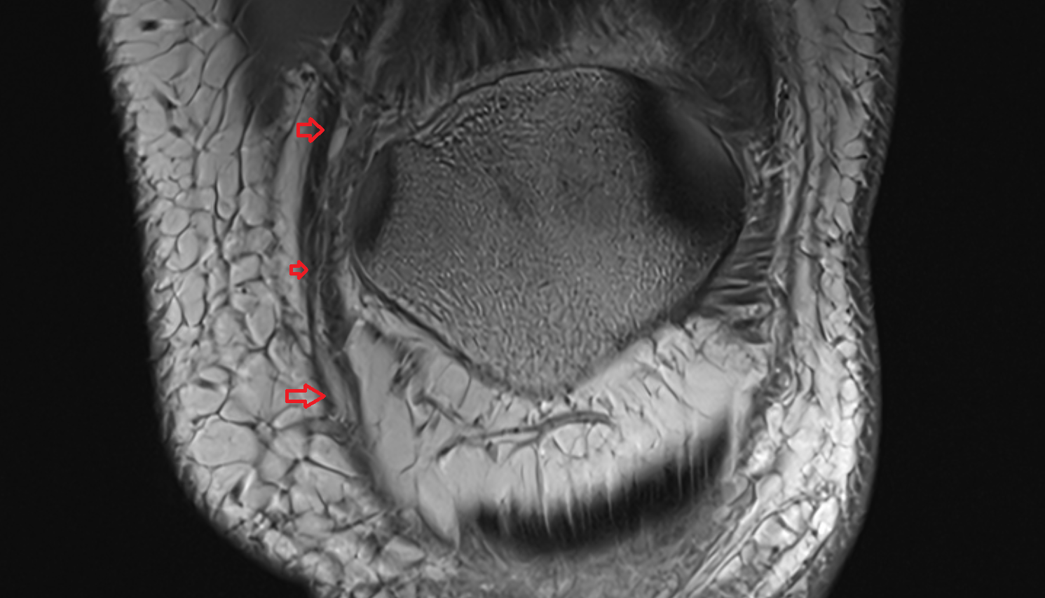 Medial patellar retinaculum coronal   cross sectional anatomy 3T MRI AI enhanced  radiology  anatomy image-img-00000-00000