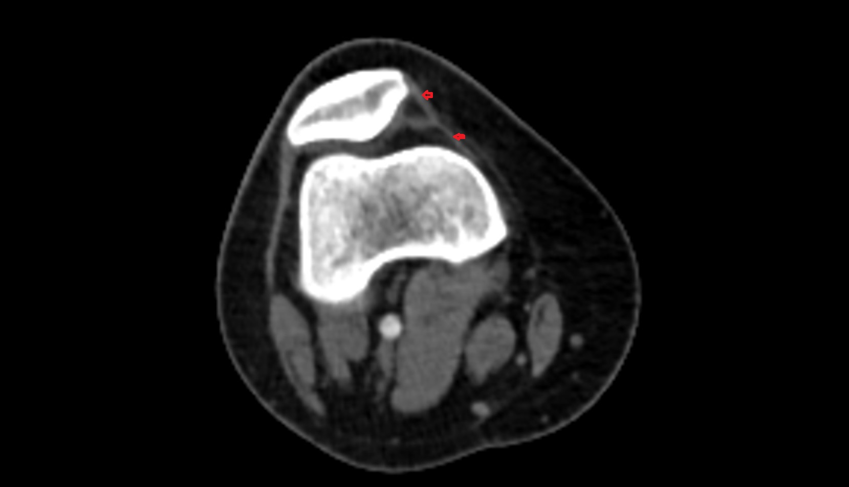Medial patellar retinaculum ct axial image