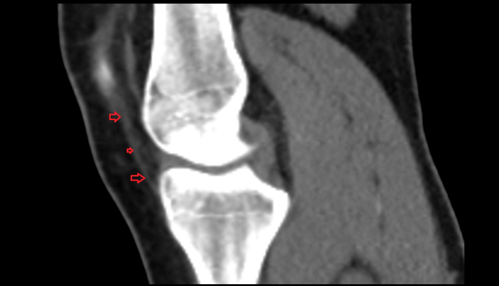 Medial patellar retinaculum ct sag image