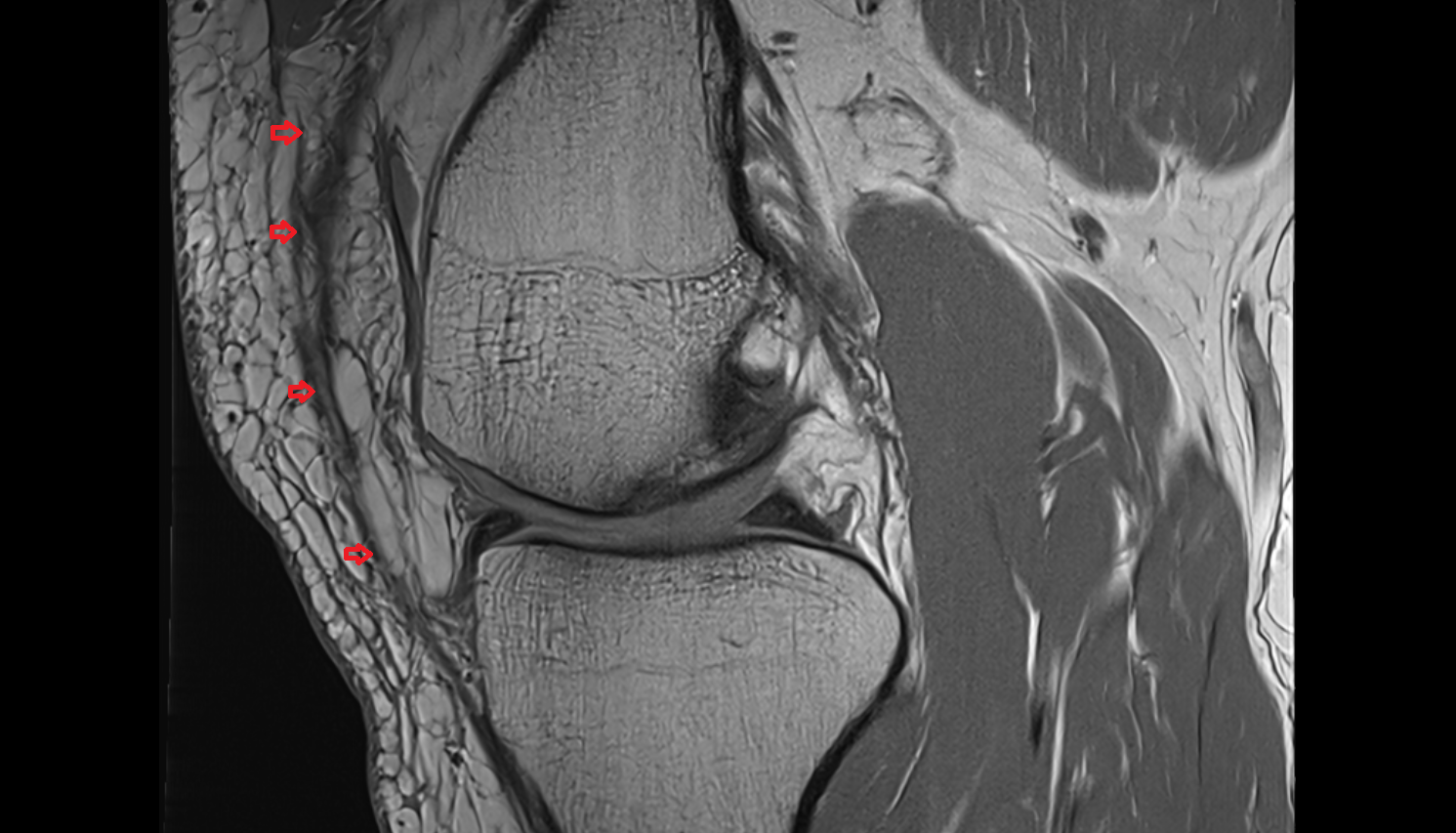 Medial patellar retinaculum sag  cross sectional anatomy 3T MRI AI enhanced  radiology  anatomy image-img-00000-00000