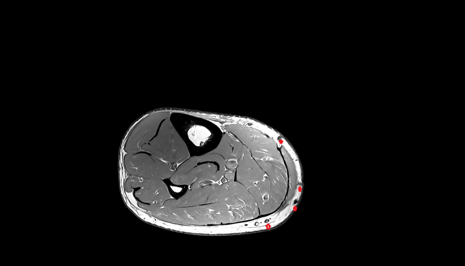 Medial perforator veins  AXIAL  cross sectional anatomy 3T MRI AI enhanced radiology image-img-00000-00000_00001
