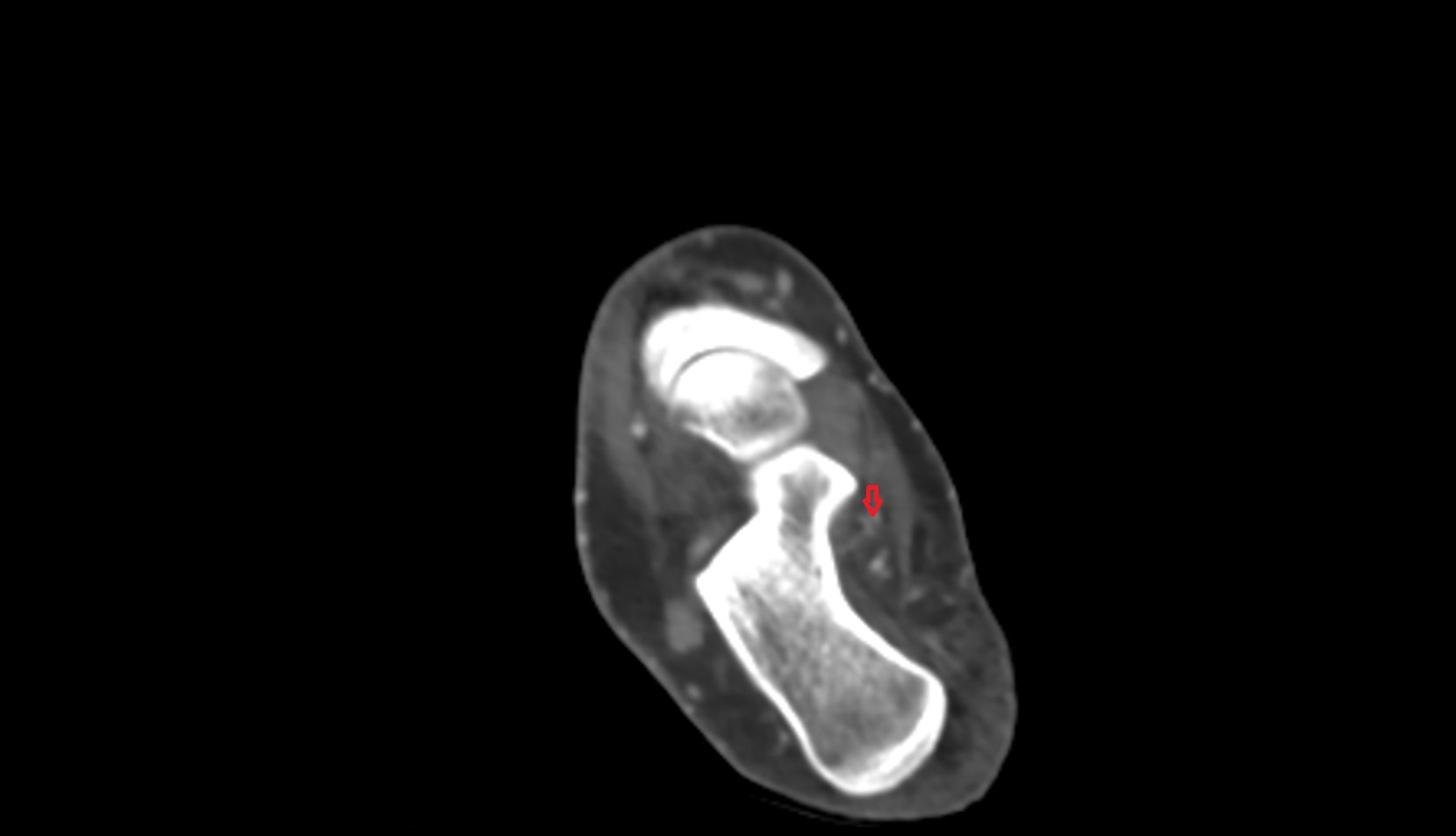 Medial plantar artery ct axial