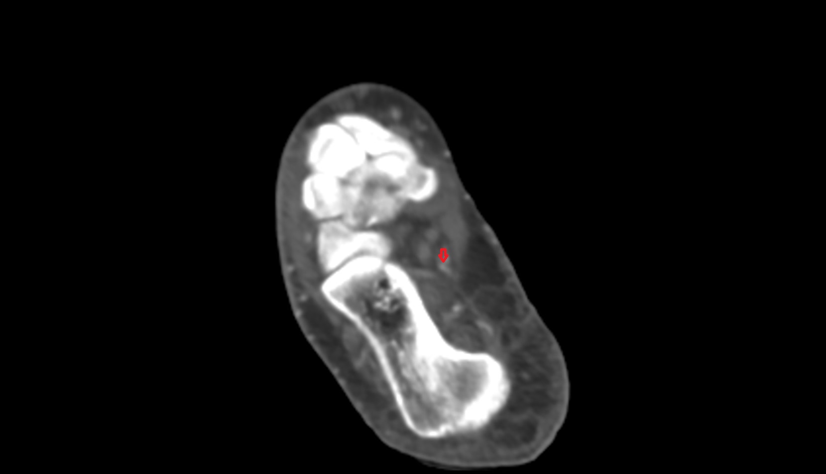 Medial plantar artery ct axial 1