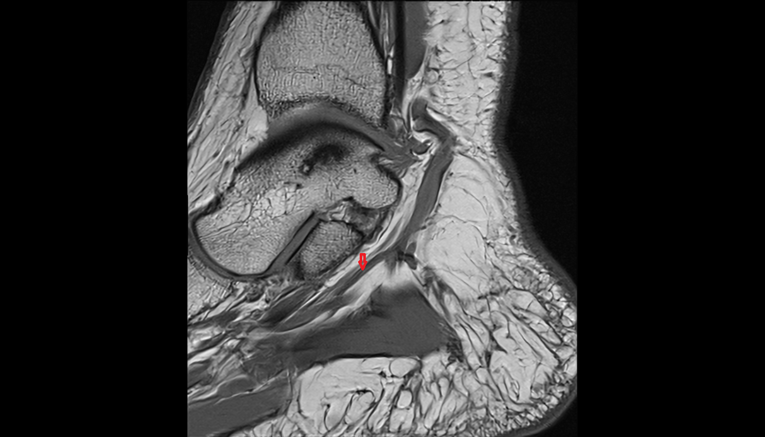 Medial plantar artery sag  cross sectional anatomy 3T MRI AI enhanced radiology image-img-00000-00000