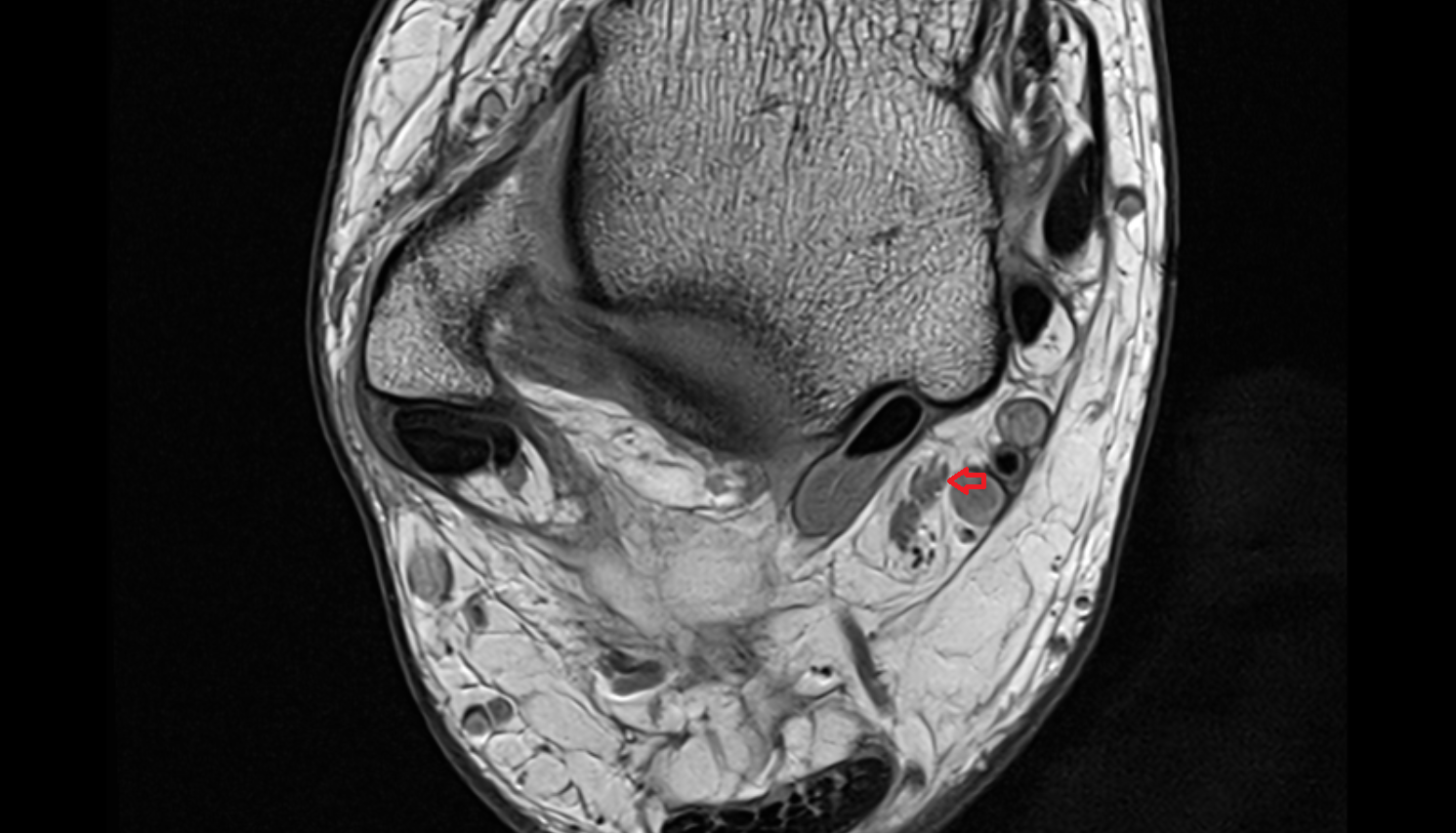 Medial plantar nerve  axial cross sectional anatomy 3T MRI AI enhanced radiology image-img-00000-00000