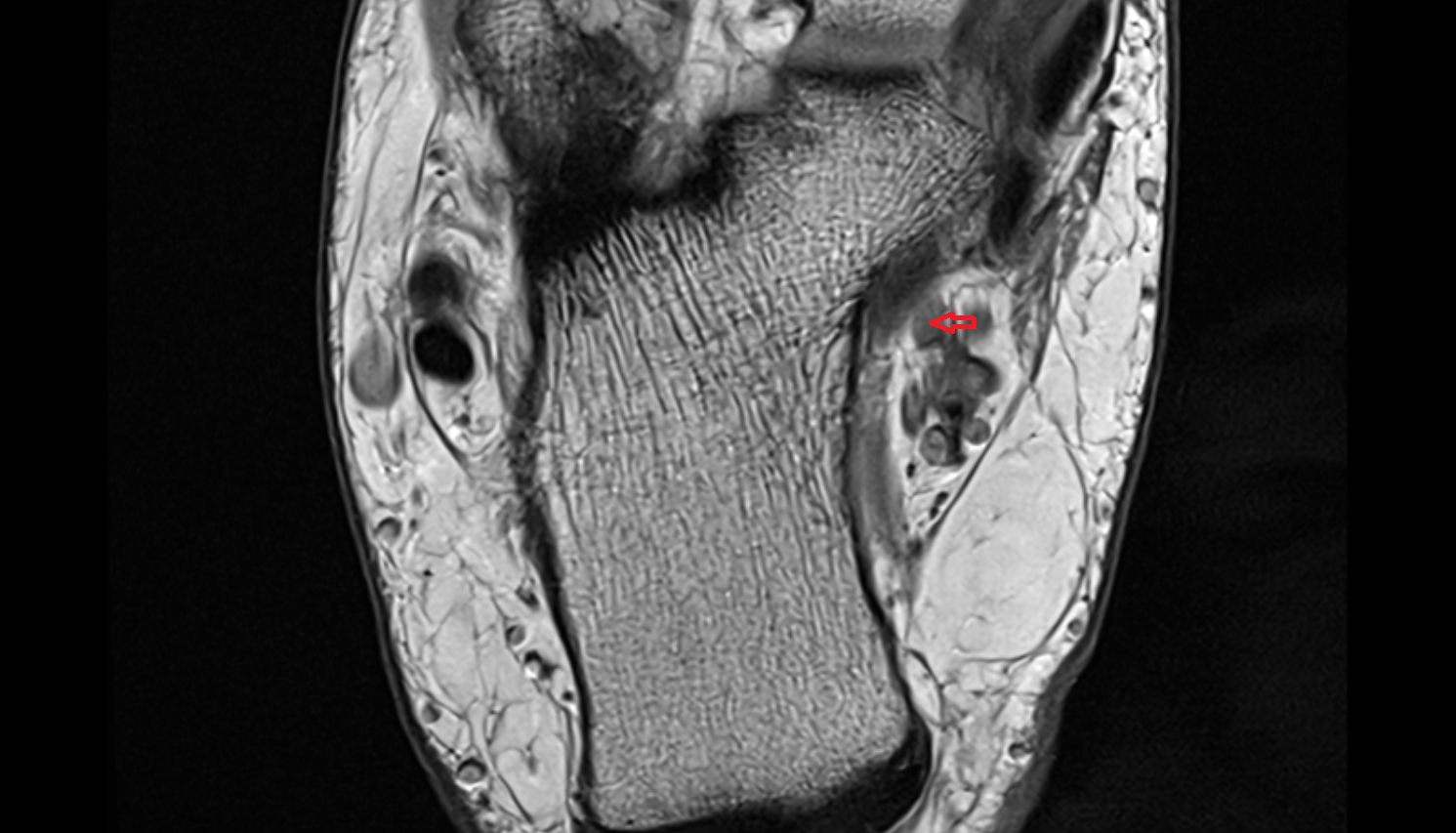 Medial plantar nerve  axial cross sectional anatomy 3T MRI AI enhanced radiology image-img-00000-00000_00001