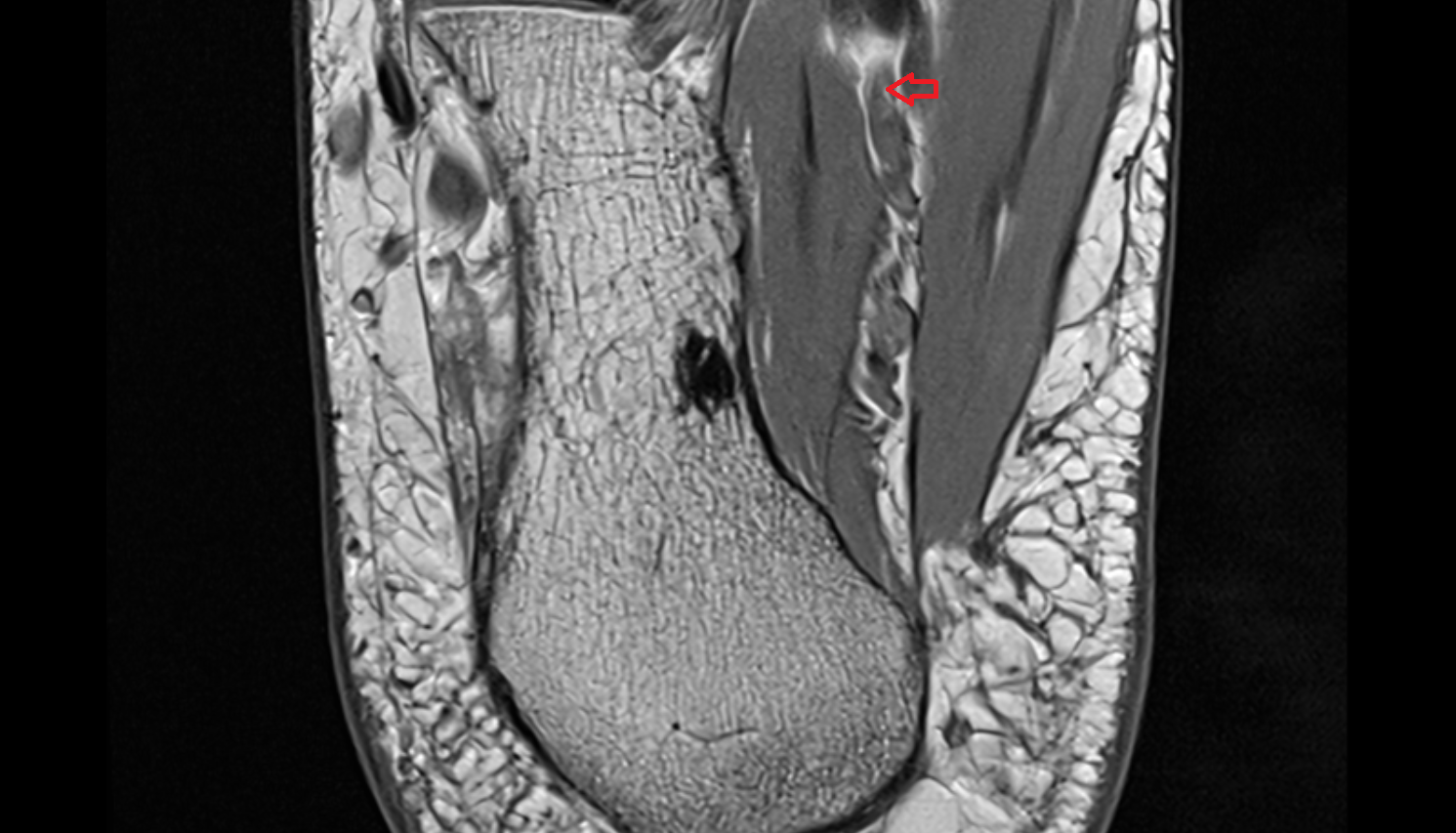 Medial plantar nerve  axial cross sectional anatomy 3T MRI AI enhanced radiology image-img-00000-00000_00002