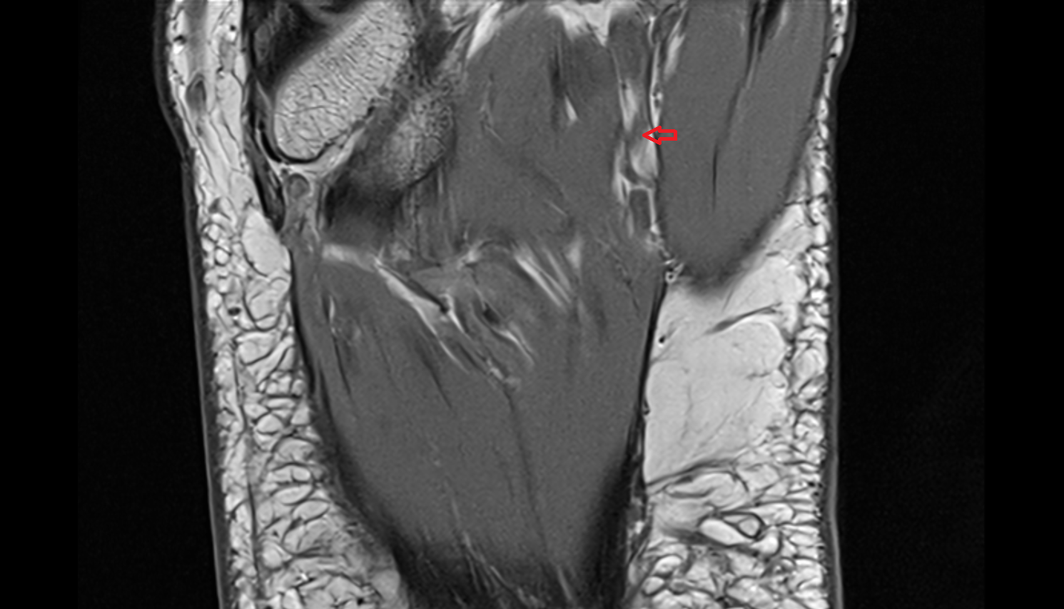 Medial plantar nerve  axial cross sectional anatomy 3T MRI AI enhanced radiology image-img-00000-00000_00003