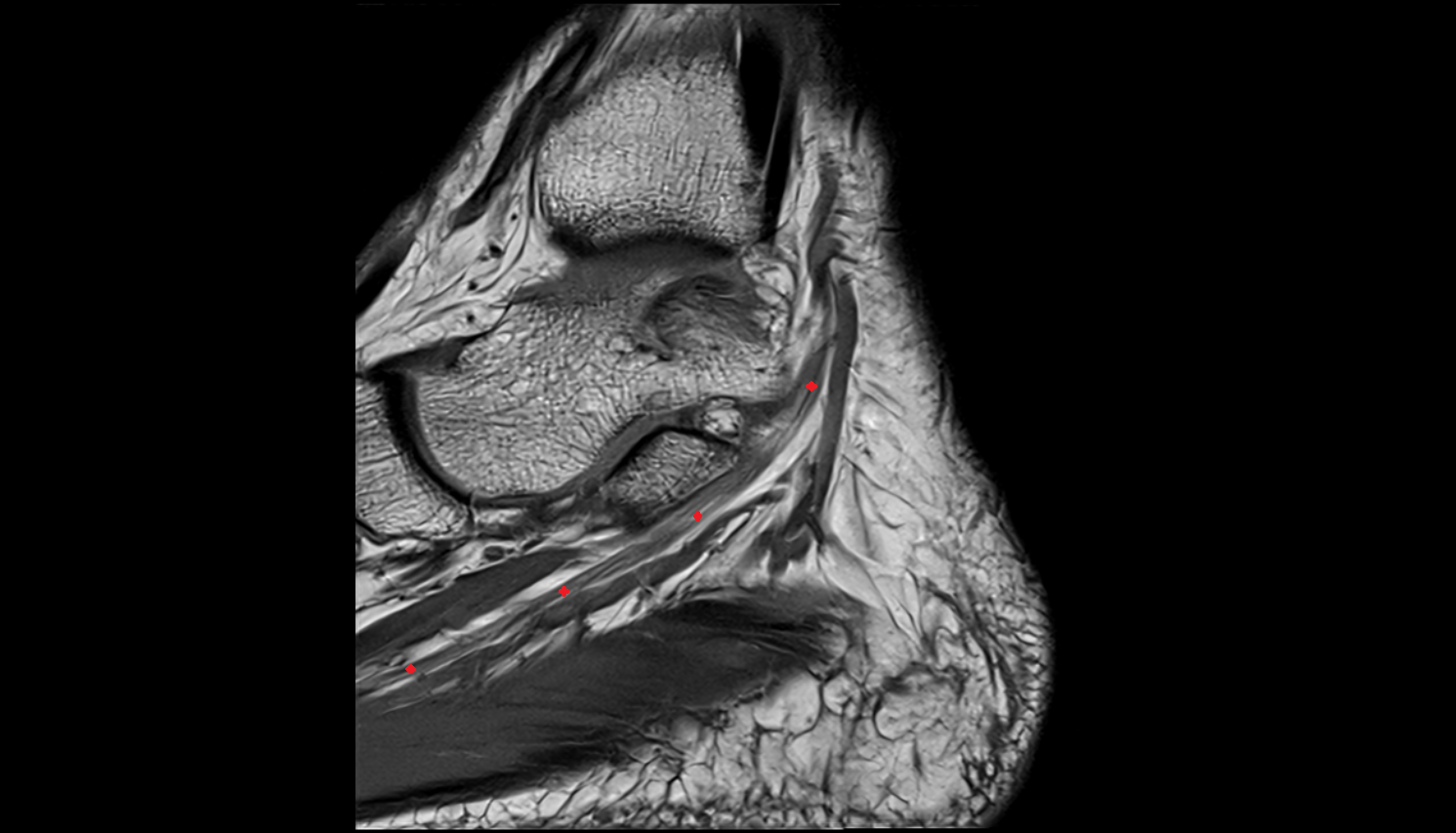 Medial plantar nerve  sag cross sectional anatomy 3T MRI AI enhanced radiology image-img-00000-00000