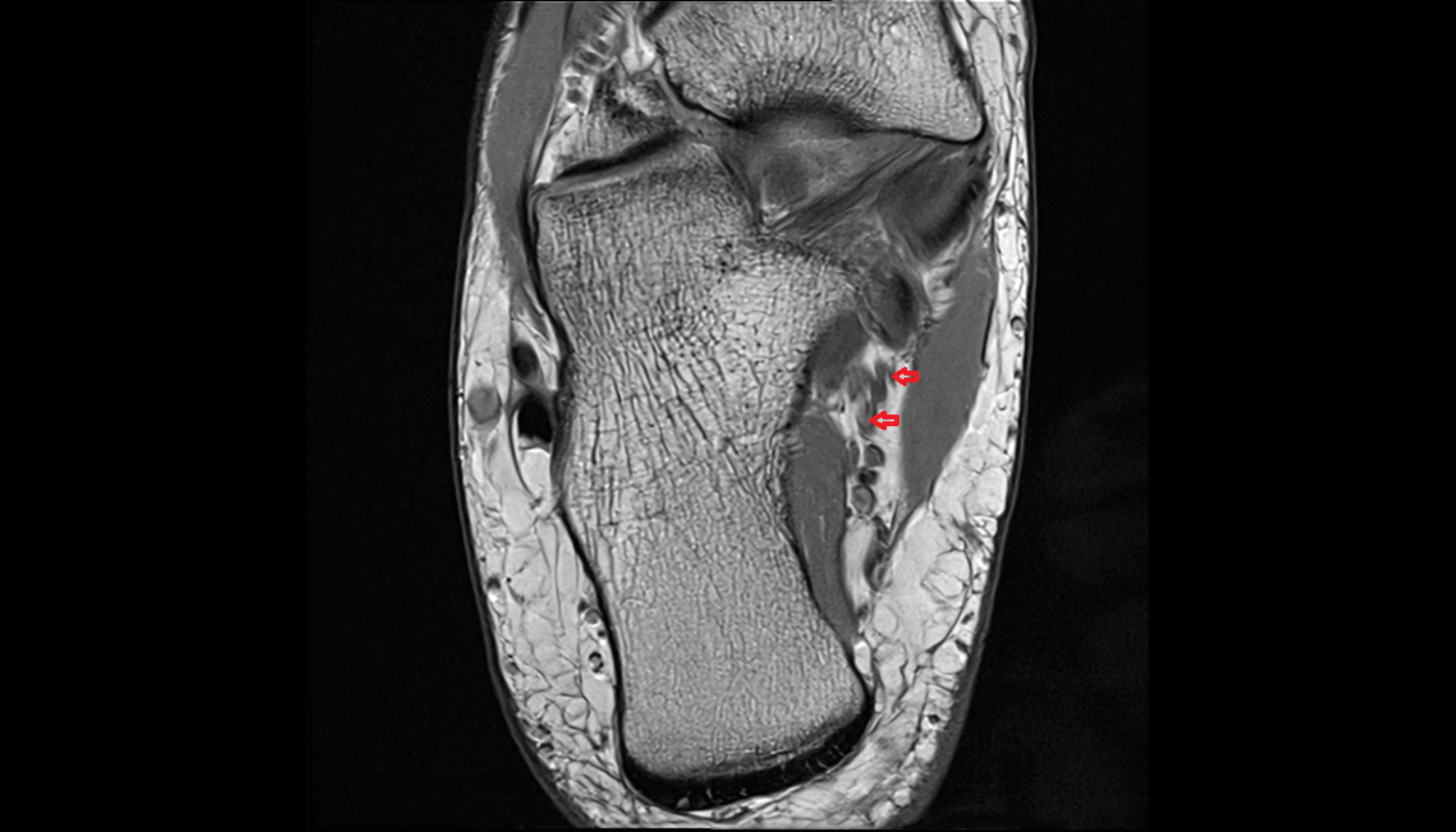 Medial plantar veins  AXIAL  cross sectional anatomy 3T MRI AI enhanced radiology image-img-00000-00000