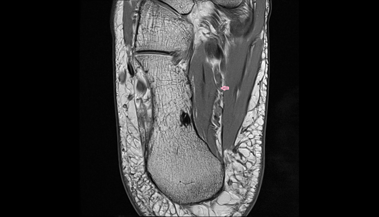 Medial plantar veins  AXIAL  cross sectional anatomy 3T MRI AI enhanced radiology image-img-00000-00000_00001