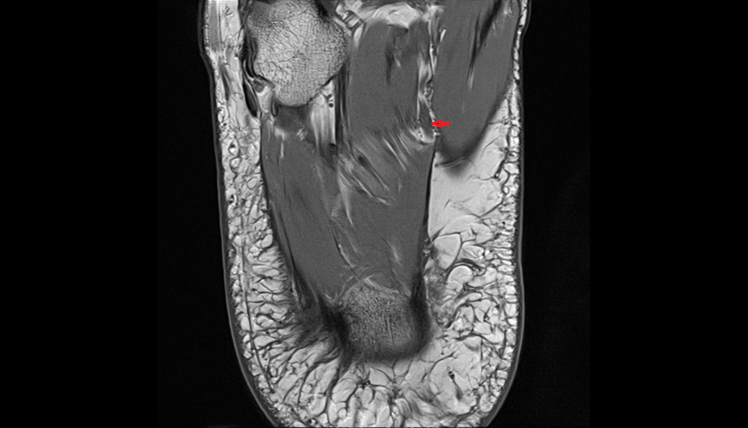 Medial plantar veins  AXIAL  cross sectional anatomy 3T MRI AI enhanced radiology image-img-00000-00000_00002
